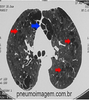 ATUALIZA��O SOBRE NOVAS DROGAS EM DPOC: LEIA O RESUMO DESSE IMPORTANTE ARTIGO.